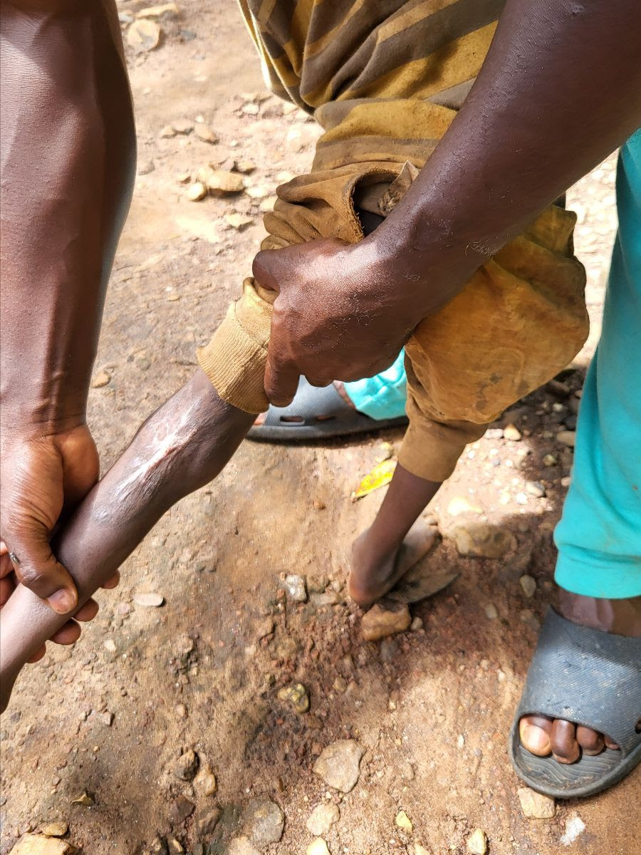 Photo of Banuma's leg after surgery