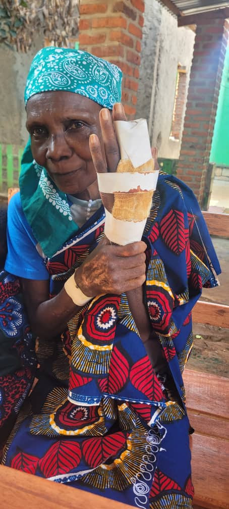 Photo of Denise showing her hands, bandaged at Ubuntu Clinique after a bad burn.