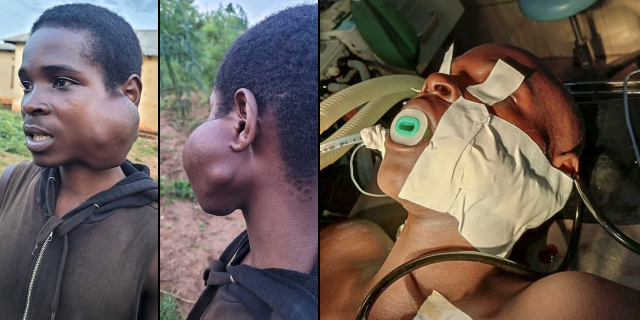 photos of Emmanuel before surgery with the large facial tumor he suffered from