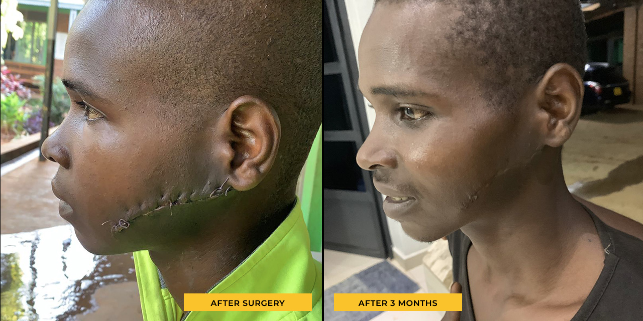 photos of Emmanuel after surgery showing the healing progress of the stitches and scar